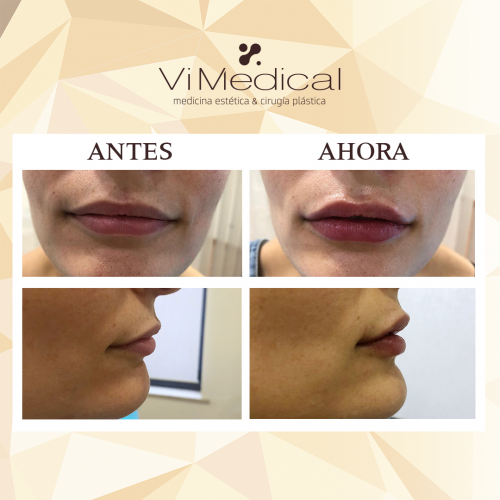 Aumento y perfilado de labios con �cido hialur�nico